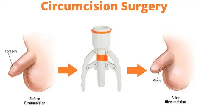 ZSR Surgery Circumcision in Jaipur